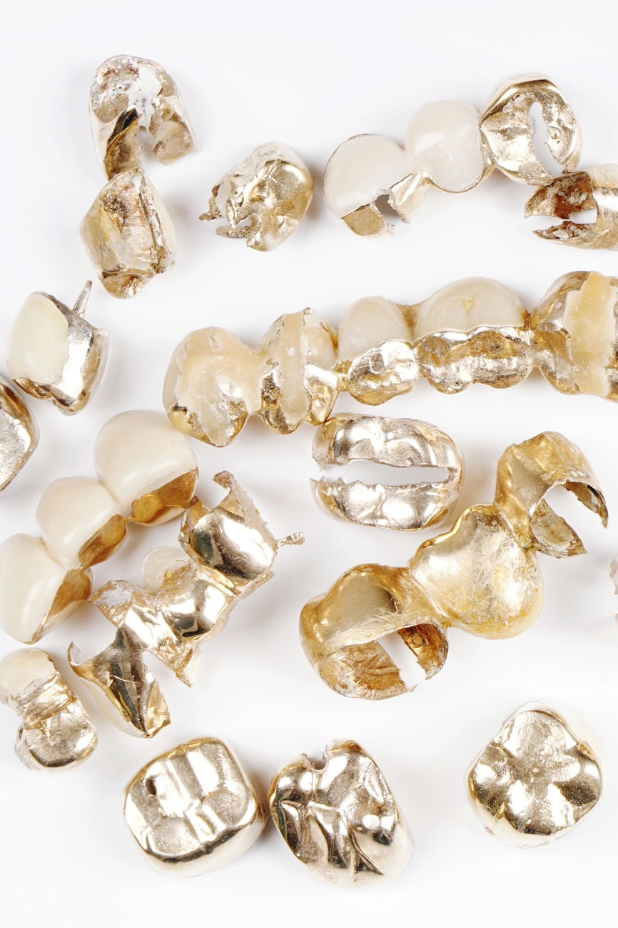 zahngold-ankauf-verkaufen-berlin-potsdam-2